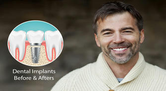 Dental Implants: Your Best Choice? Let the Data Tell You!