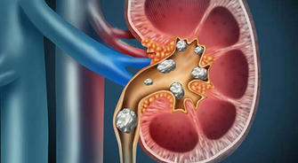 Uncovering Kidney Stones: Causes, Symptoms, and the Latest Treatment Methods